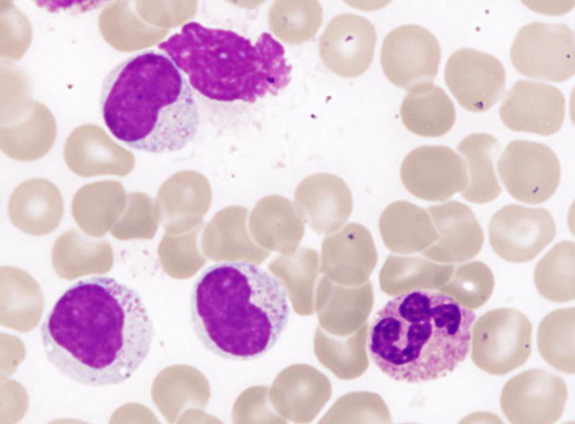 5x10 9 /l LGL (cytologicky s jistotu