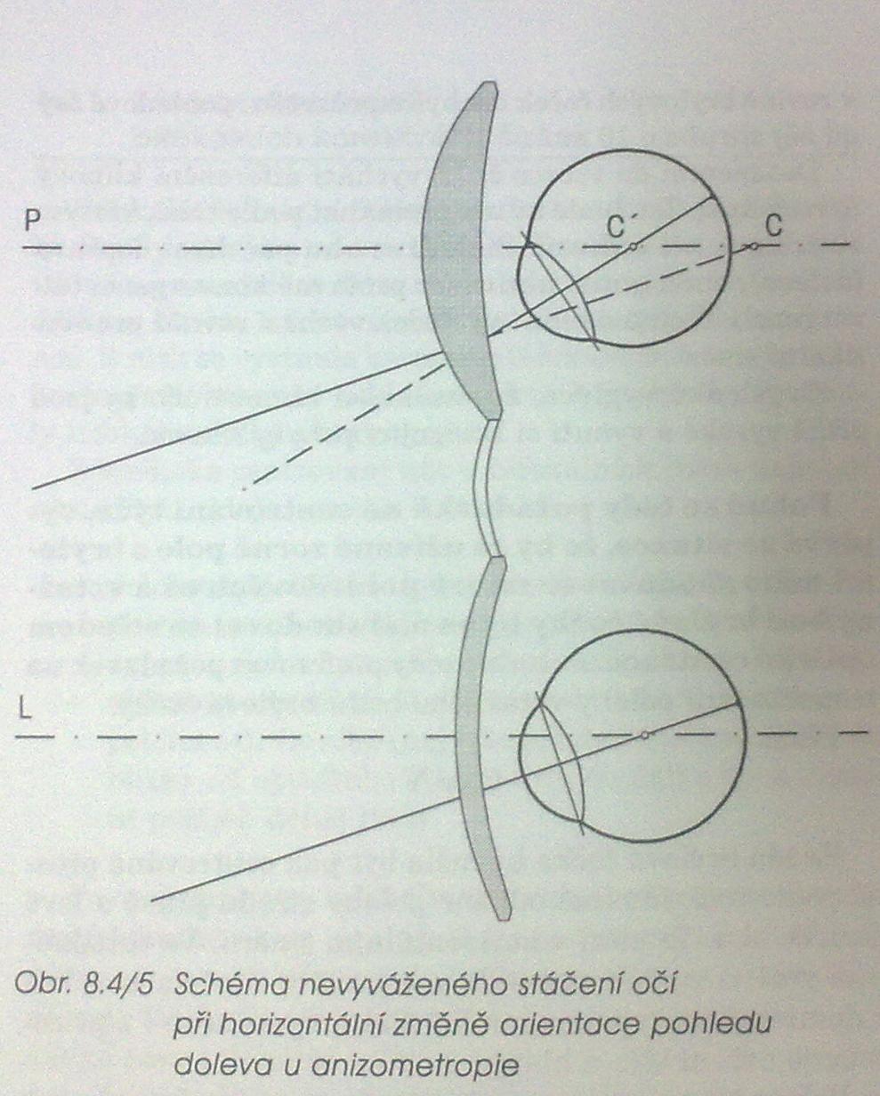 Centrování anizometropické korekce Dle upravené Prenticeho rovnice je možné vypočítat konvergenční diferenci pravého