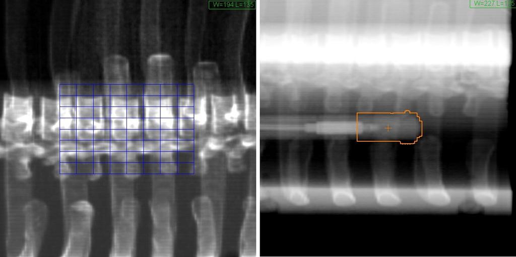 připomenout, že součástí přípravy plánu se sledováním Xsight Lung jsou také kroky jako pro plán s použitím systému Xsight Spine, jelikož prvotní zarovnání pacienta probíhá podle struktur páteře. Obr.