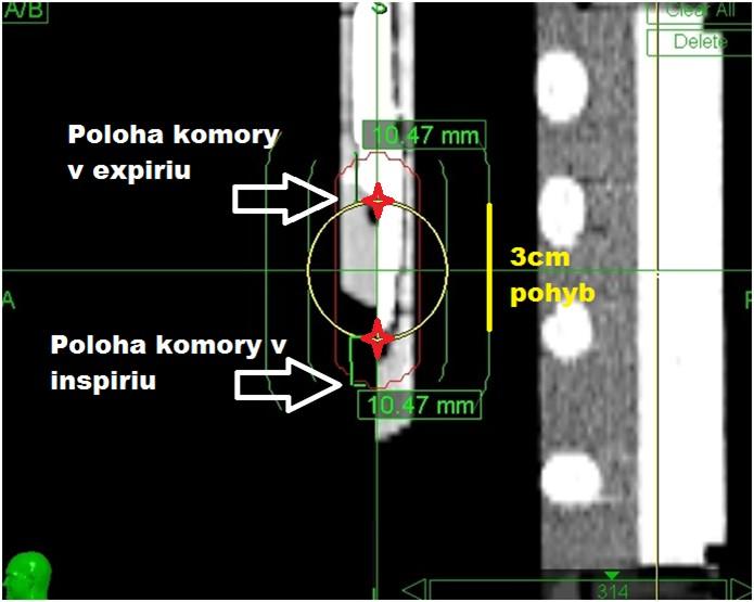 zelených čar) a velikost kolimátoru 30 (žlutý kruh). Červené symboly na obrázku znázorňují měřící bod ionizační komory v poloze výdechu a nádechu. Obr. 6.3.1- Poloha ionizační komory v nádechu a výdechu (expiriu a inspiriu).