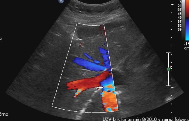 Dopplerovská ultrasonografie trifazická