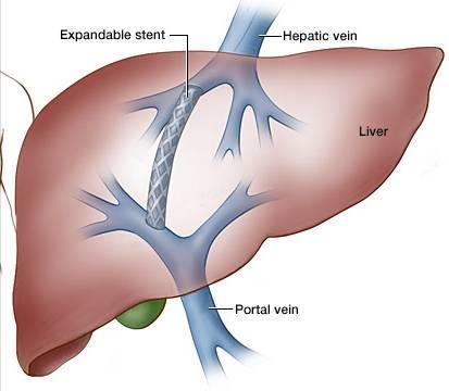 Doppler. UZ TIPSu TIPS = transjugular intrahepatic portosystemic shunt častý výskyt stenóz (25-80% v 1.