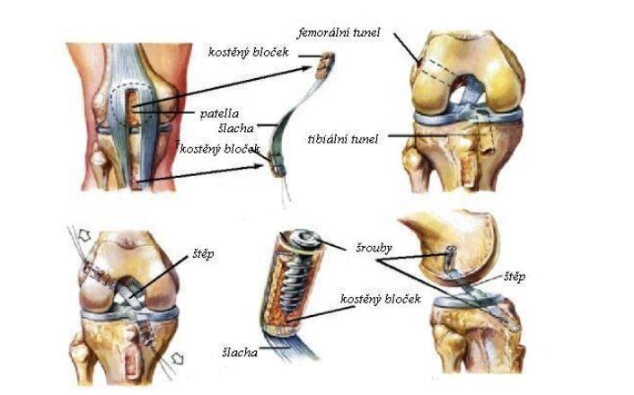 Obr. 1: BTB Plastika (ACUTE KNEE AND CHRONIC LIGAMENT INJURIES, http://www.jockdoc.ws/subs/kneeligament.htm, 2009) 3.