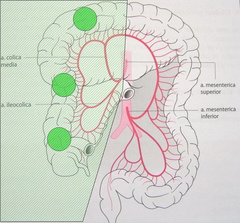 Obstrukce pravého tračníku - chirurgická léčba Resekční výkon s primární