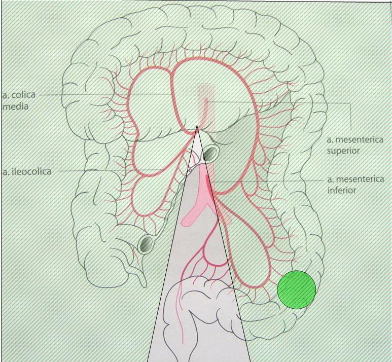 Obstrukce levého tračníku a rekta chirurgická léčba 1-dobá operace segmentální resekce s primární