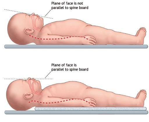 Anatomické rozdíly Neutrální poloha Prominující týlní hrbol u