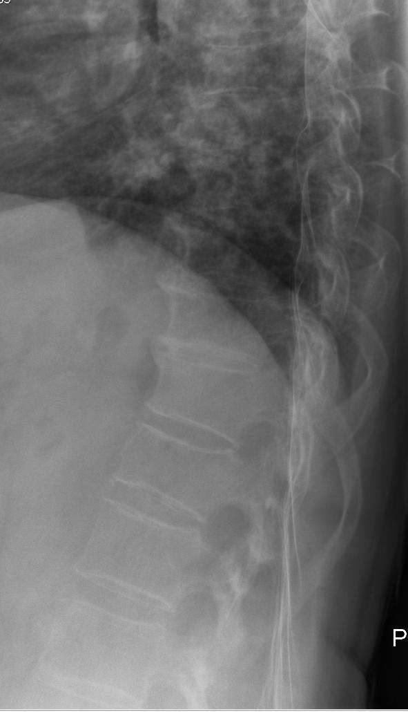 Průběh hospitalizace konzervativní přístup, analgetika, prevence TEN, prokinetika, bilance tekutin. Rehabilitace-postupná vertikalizace v Jewett. ortéze.