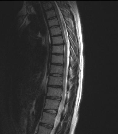 Na konci ledna 2015 nemocná absolvovala kontrolu na neurochirurgické ambulanci. Dominuje porucha chůze stejná jako před operací, zlepšila se citlivost na břiše.