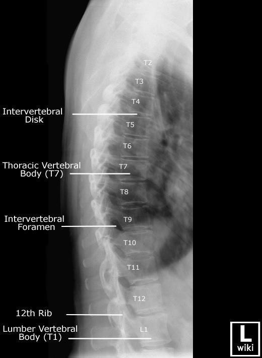 Příloha 4 Boční projekce Zdroj:www.wikiradiography.netThoracic spine [online]. 2016 [cit.