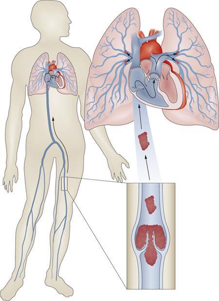 WARFARIN - léčba a profylaxe