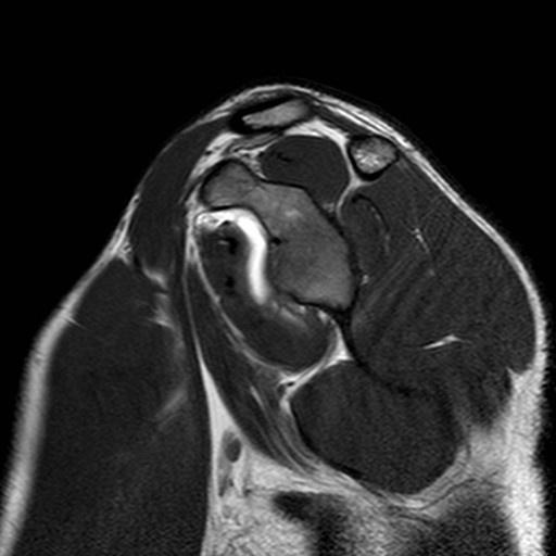 Anatomie m. supraspinatus m. deltoideus m. infraspinatus m.