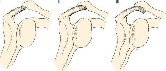 coracoacromiale, acromion Klinické projevy: bolesti, ztuhlost a omezení pohybu Příčiny osteofyty - acromion, AC skloubení kongenitální konfigurace