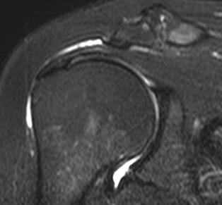 sval ruptura Postižení zejména šlachy m. supraspinatus Tendinóza m.