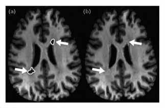 MR u roztroušené sklerózy Ceccarelli a spol. frakční anizotropie průměrná difuzivita radiální difuzivita OBRÁZEK 2.