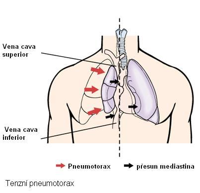 Léčba vyvolávající příčiny je bezodkladná, život zachraňující (drenáž pneumotoraxu, snížení agresivity umělé plicní ventilace, punkce perikardu).