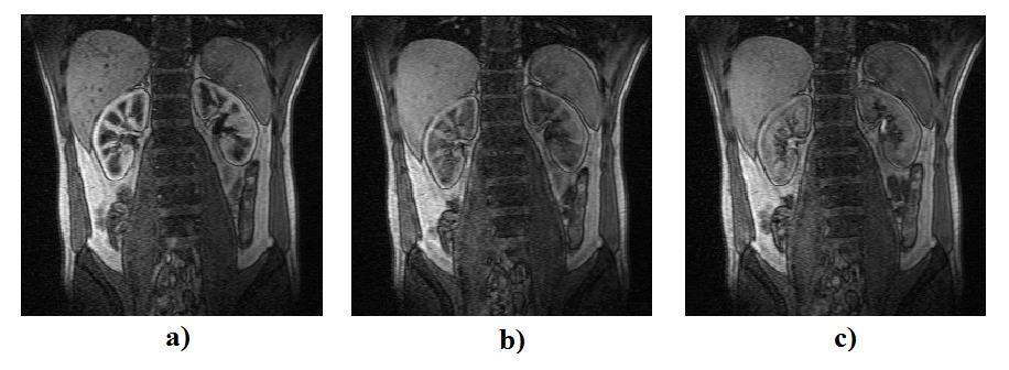 Vedlejší snímek ukazuje přesun kontrastní látky do ledvinové dřeně, zde již však není tolik patrná jako v ledvinové kůře.