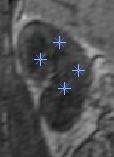 2: Snímek ledvin a okolí 7.1.3 Určení počátečních bodů kontury Po načtení a zobrazení prvního snímku (prostřední snímek z 3D série) se manuálně určí počáteční body (obr 7.