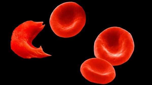 1. pilíř Optimalizace červené krevní řady předoperačně detekce anémie identifikace chorob vedoucích k anémii léčba plán dalšího vyšetření léčba deficitu železa, chronické