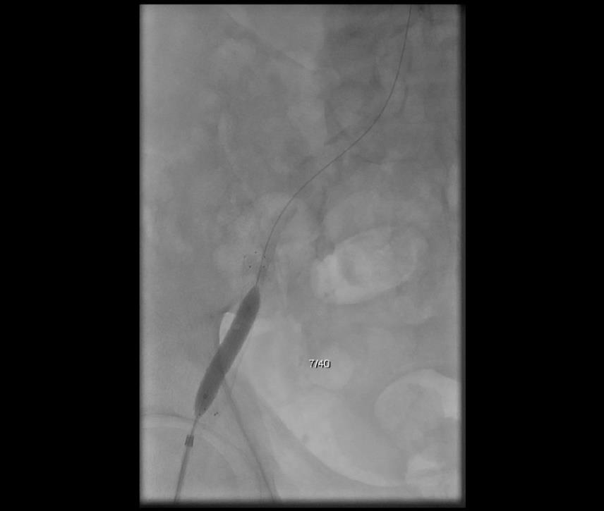 Obrázek 2 Dodilatace samoexpandibilního stentu balónkovým katetrem Zdroj: Winmedicalc FN Plzeň Závěr: 6. 12. 2016 provedena PTA a stentáž pravé zevní iliky. Přístup zajištěn femosaelem.