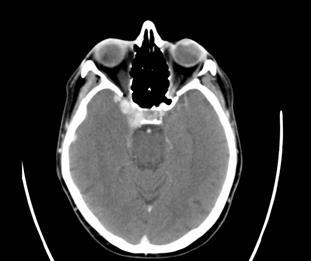 22. 10. 2016 indikováno CT orbit a mozku. Vyšetření bylo provedeno po aplikaci k.l. i.v.. Vyšetření ukázalo v.s. karotidokavernozní píštěl vpravo (meningiom en plaque málo pravděpodobný). V.s. cévní malformace vpravo.