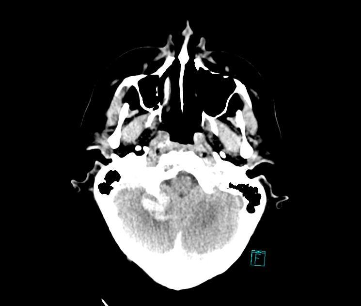 Obrázek 9 Kontuze v pravé mozečkové hemisféře Zdroj: Winmedicalc FN Plzeň 5. 10. 2016 přeložen k observaci na Neurochirurgickou jednotku intenzivní péče.