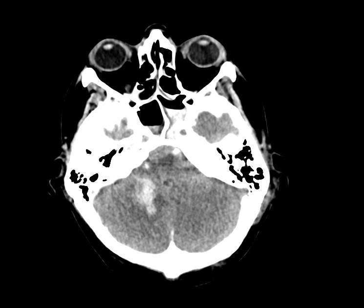 5. 10. 2016 22:50 provedeno druhé CT vyšetření. Bez průkazu plicní embolizace. V levém dolním plicním laloku nález odpovídá rozvoji zánětlivého procesu.