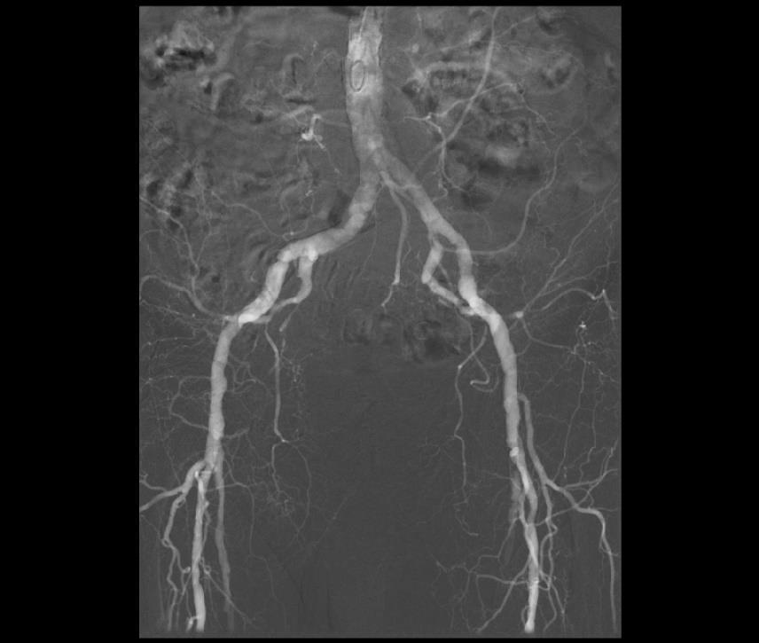Obrázek 12 Aortoarteriografie pánve a DK: vpravo
