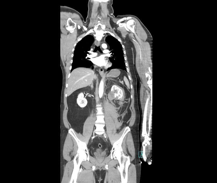 Obrázek 14 Perirenální hematom levé ledviny Zdroj: Winmedicalc FN Plzeň 7. 9. 2016 17:54 pacient poslán na CT vylučovací urografii s aplikací k.l. i.v. Neprokázán únik kontrastní látky mimo dutý systém ledvin.