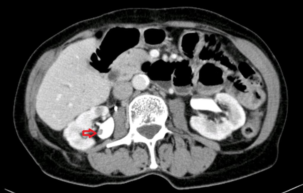 54 vpravo. Z osobní anamnézy bez pozoruhodností, abúzus kouření. Dle nativního CT zjištěna dilatace kalichopánvičkového systému (KPS), bez průkazu urolitiázy v průběhu močových cest.
