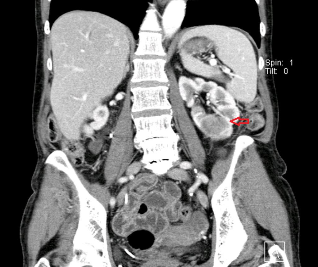 55 Obr. 2. CT IVU tumorózní expanze v dolním pólu levé ledviny CDC Fig.