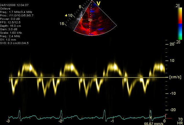 Sepsis induced changes of diastolic function: