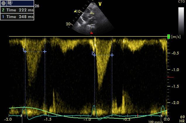 Tei index LV/RV - Isovolemic