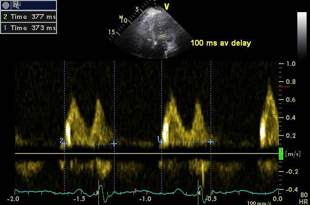 Total isovolumic time (t-ivt) time in which LV neither