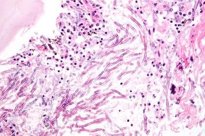 -typically in imunocompromised -2-3 days after viremia -Pneumococcus,