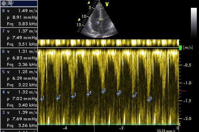 Higher transmitral E