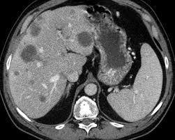 onemocněním (cirhóza, steatohepatitis, atd.) a u lézí < 5 mm v průměru.