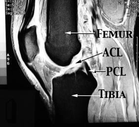 Klasickým kombinovaným poraněním je nešťastná triáda, kdy se jedná o rupturu LCM (ligamentum collaterale mediale), LCA a mediálního menisku