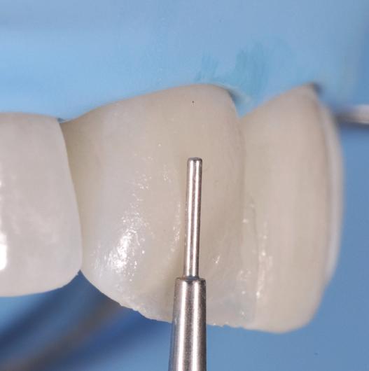 Po nanesení vrstvy dentinového kompozitu, ale ještě před jeho polymerizací, umístěte tenčí kuželovitý pracovní konec na sklovinu ošetřovaného zubu.