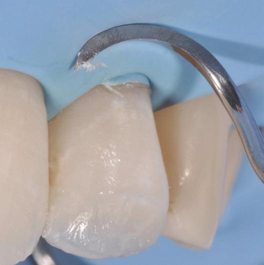 Díky vhodnému zahnutí pracovních konců je ideální pro odstraňování přebytků zejména z oblasti krčků předních zubů a mezizubních oblastí molárů.