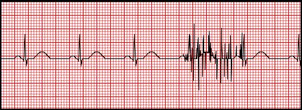 EKG Artefakty http://mauvila.