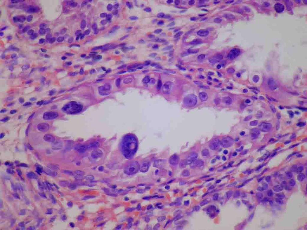 karcinomu dříve označován jako carcinoma in