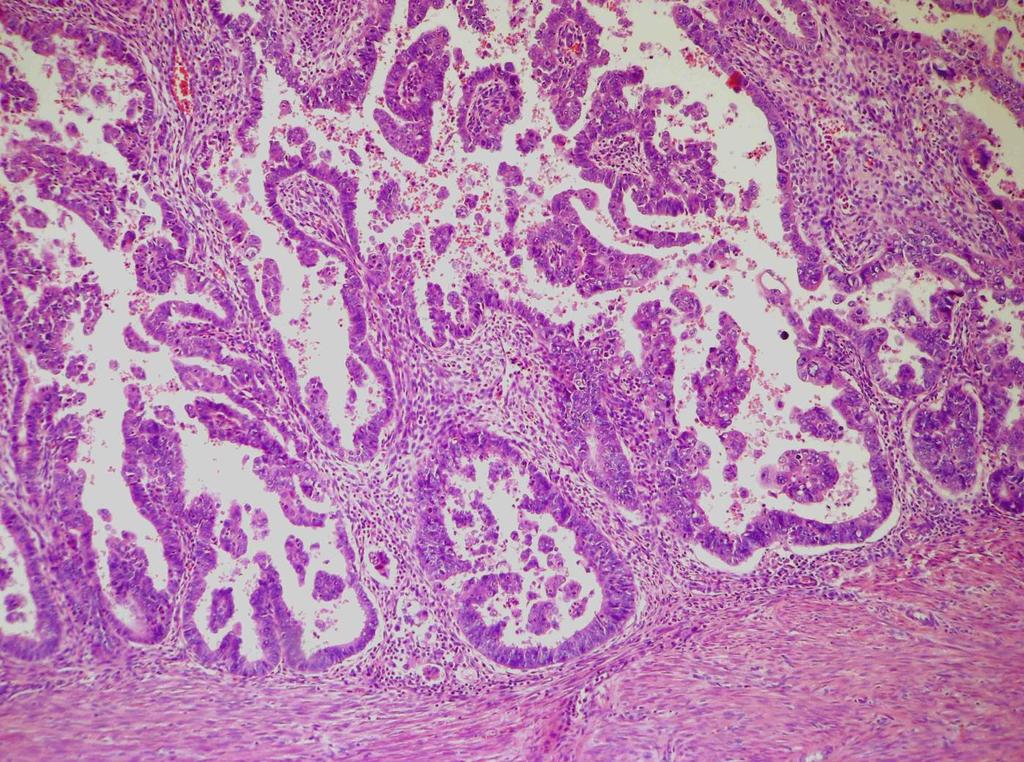 Typ II high-grade karcinom není souvislost s hyperestrinismem agresivní chování histologické subtypy: -