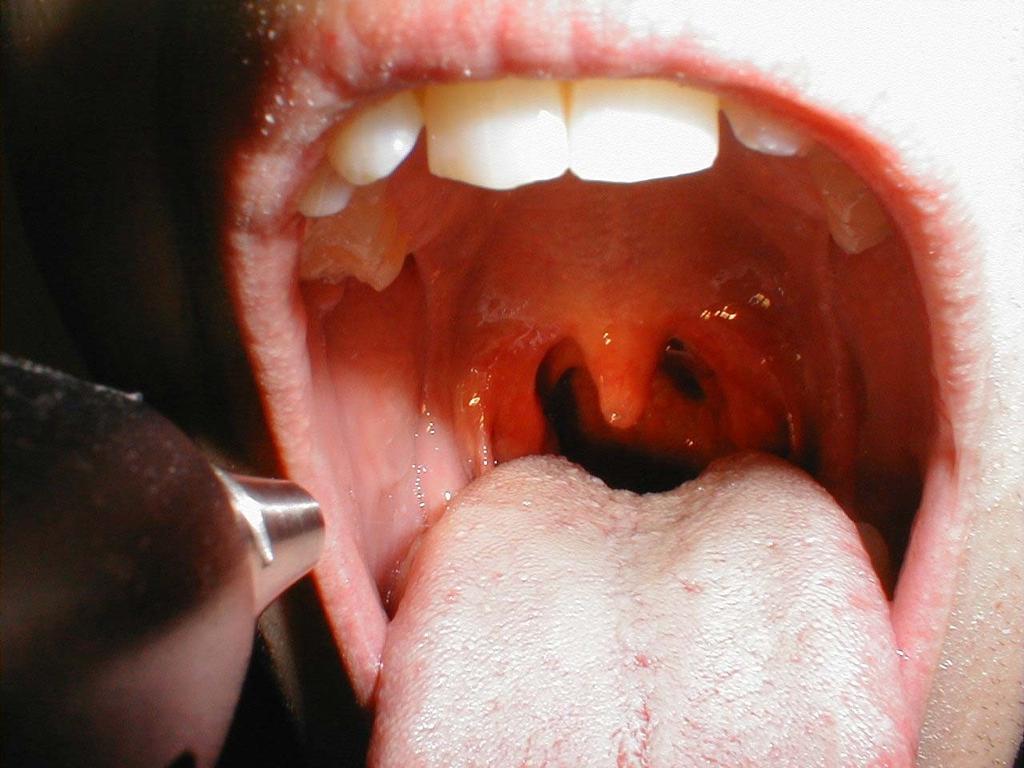 Tonsilopharyngitis