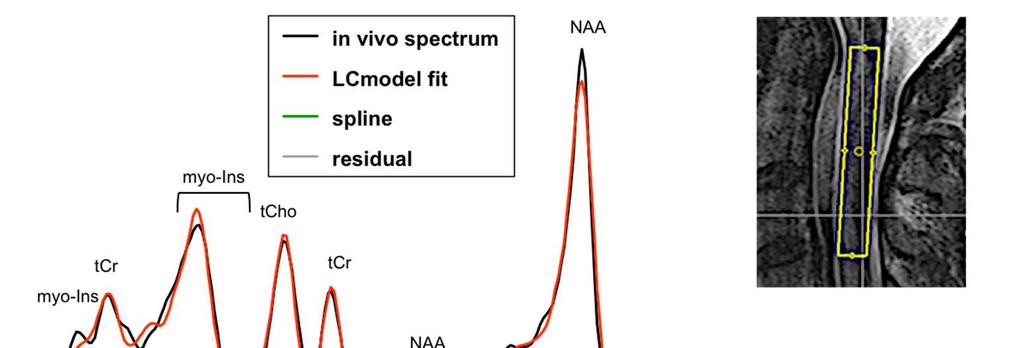 MR 1H SPEKTROSKOPIE Posouzení neurochemické