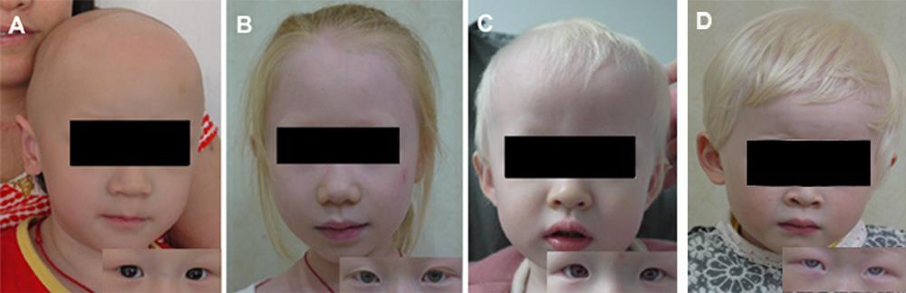 5 OCA OKULOKUTÁNNÍ ALBINISMUS Při okulokutánním albinismu se jedná o stav, který zahrnuje mutace genů zprostředkující syntézu melaninu.