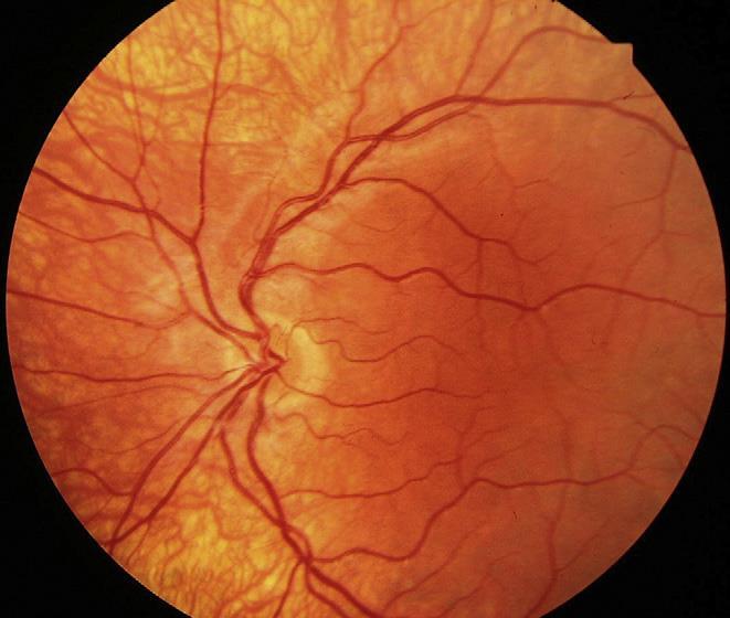 po roce). Nystagmus u albinismu může zabránit adekvátnímu zobrazení optické koherentní tomografie. (Levin et al., 2011) Osoby trpící albinismem nejvíce omezuje v rámci zraku makulární hypoplasie.