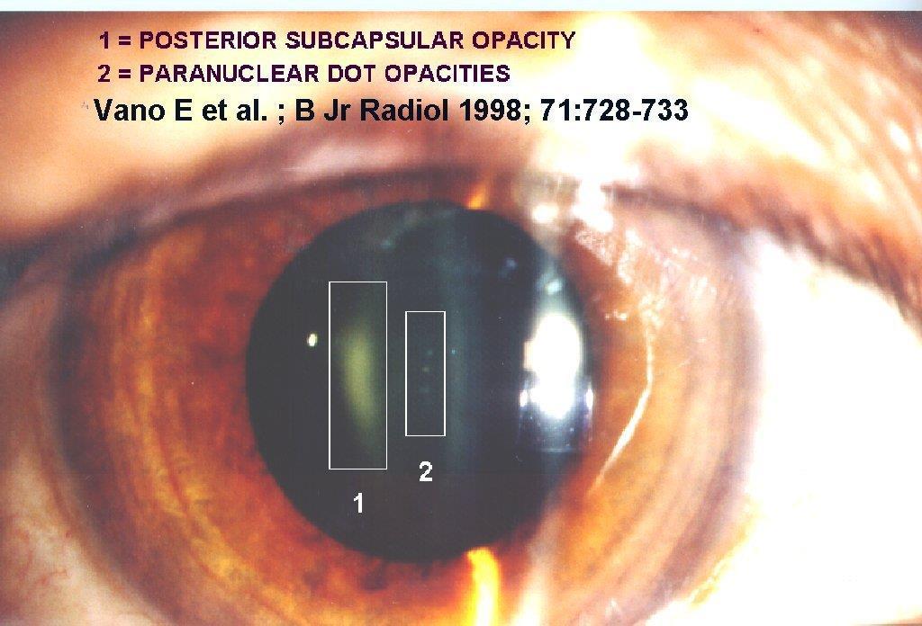 Deterministické účinky: Bezpečnost Oči pacientů Oční čočka je vysoce radiosenzitivní a