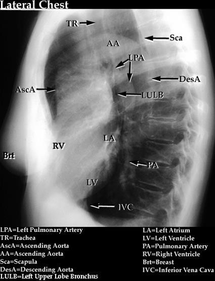 Boční projekce hrudníku Cílová anatomie/patologie: Rozlišení mezi vzestupnou částí aorty (AA) a levou plicní