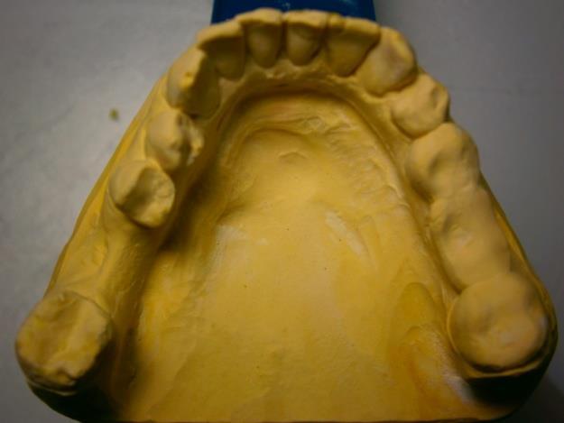Lékařem byl zadán wax up zubů 15 25, 33 43, 35 37, 45 47 do anatomického tvaru tj.
