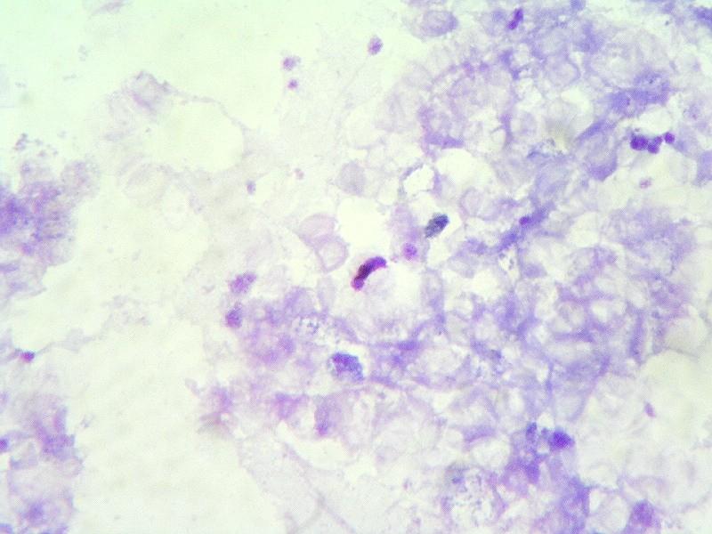 pacient bez chemoprofylaxe Plasmodium falciparum 6,56% pacientka s chemoprofylaxí